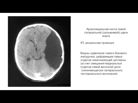 Арахноидальная киста левой латеральной (сильвиевой) щели мозга КТ, аксиальная проекция. Видны