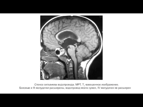 Стеноз сильвиева водопровода. МРТ, Т1-взвешенное изображение. Боковые и Ill желудочки расширены,