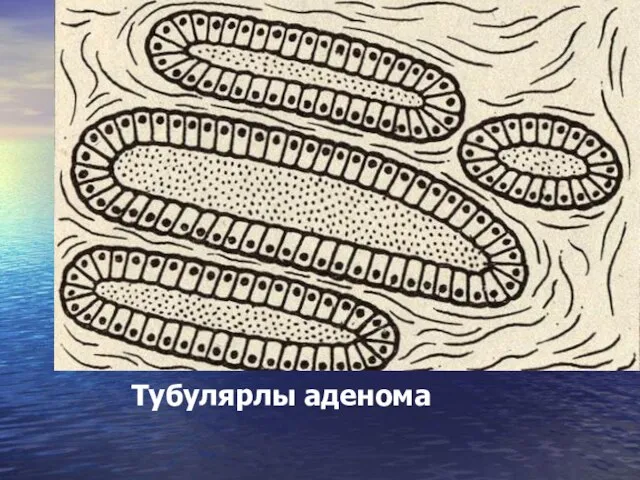 Тубулярлы аденома