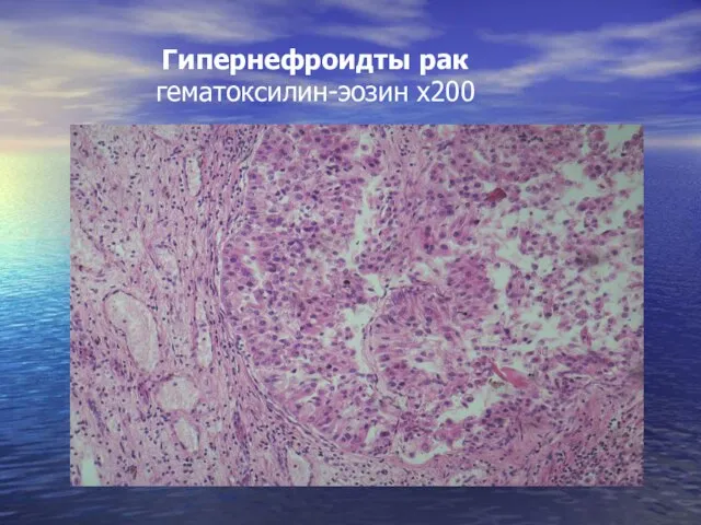 Гипернефроидты рак гематоксилин-эозин х200