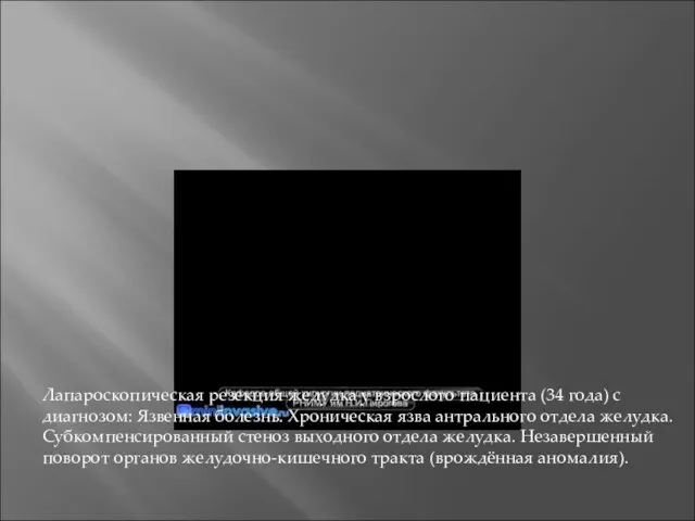 Лапароскопическая резекция желудка у взрослого пациента (34 года) с диагнозом: Язвенная