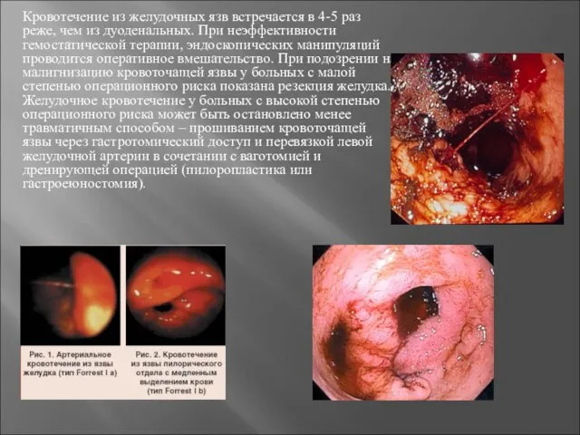 Кровотечение из желудочных язв встречается в 4-5 раз реже, чем из
