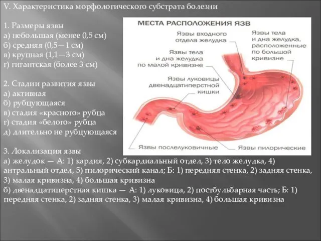 V. Характеристика морфологического субстрата болезни 1. Размеры язвы а) небольшая (менее