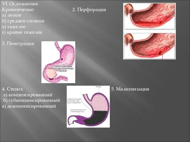 VI. Осложнения Кровотечение: 2. Перфорация а) легкое б) средней степени в)