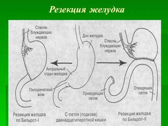 Резекция желудка