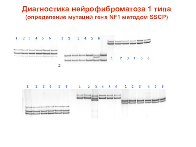 Диагностика нейрофиброматоза 1 типа (определение мутаций гена NF1 методом SSCP) 1