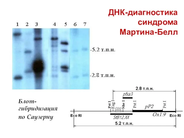 ДНК-диагностика синдрома Мартина-Белл Блот-гибридизация по Саузерну