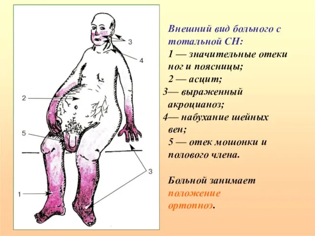 Внешний вид больного с тотальной СН: 1 — значительные отеки ног