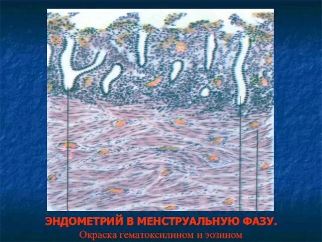 ЭНДОМЕТРИЙ В МЕНСТРУАЛЬНУЮ ФАЗУ. Окраска гематоксилином и эозином