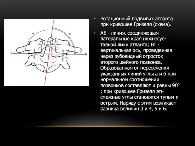 Ротационный подвывих атланта при кривошее Гризеля (схема). АБ - линия, соединяющая