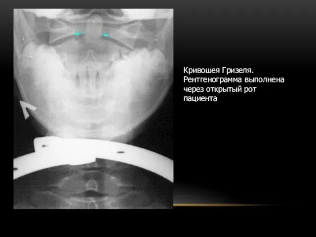Кривошея Гризеля. Рентгенограмма выполнена через открытый рот пациента