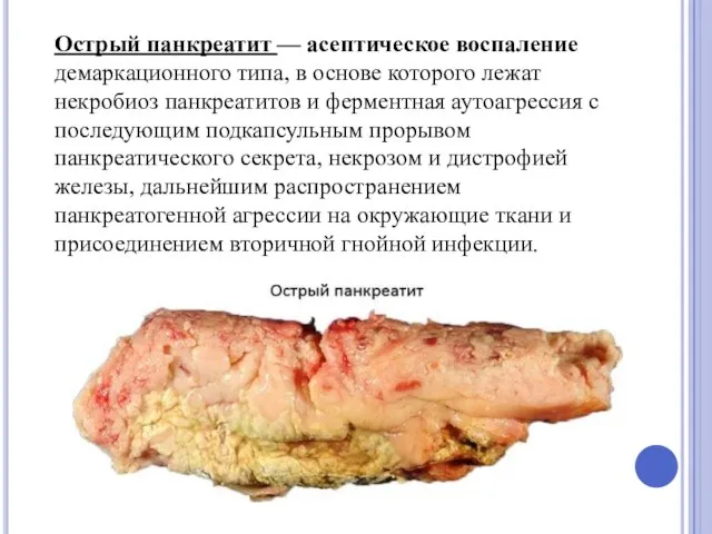 Острый панкреатит — асептическое воспаление демаркационного типа, в основе которого лежат