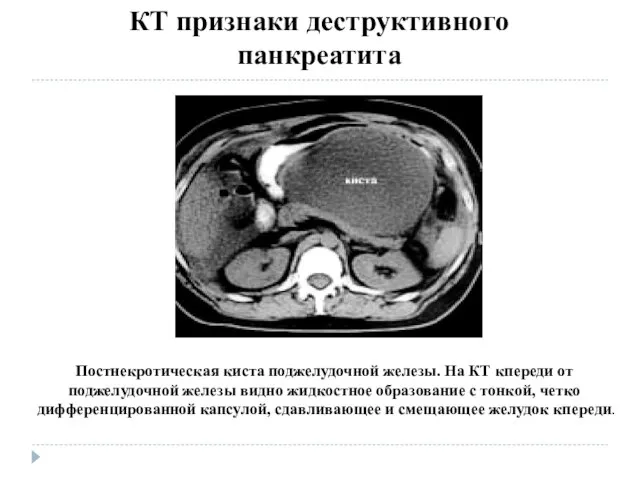 Постнекротическая киста поджелудочной железы. На КТ кпереди от поджелудочной железы видно