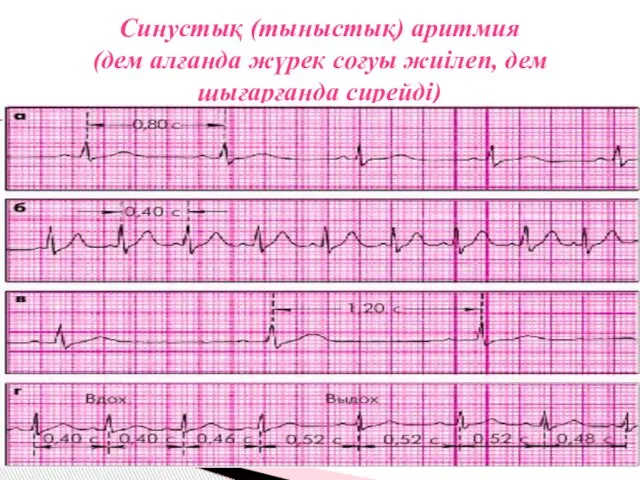 Синустық (тыныстық) аритмия (дем алғанда жүрек соғуы жиілеп, дем шығарғанда сирейді)