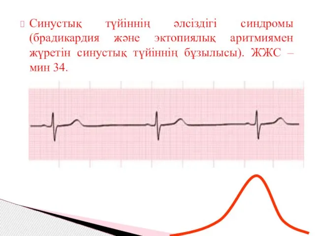 Синустық түйіннің әлсіздігі синдромы (брадикардия және эктопиялық аритмиямен жүретін синустық түйіннің бұзылысы). ЖЖС – мин 34.