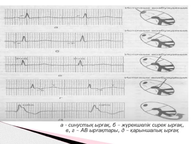 а - синустық ырғақ, б – жүрекшелік сирек ырғақ, в, г