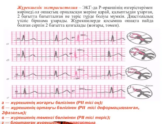 а — жүрекшенің жоғарғы бөлігінен (РII тісі оң); б — жұрекшенің