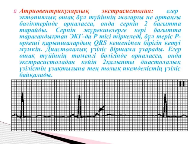 Атриовентрикулярлық экстрасистолия: егер эктопиялық ошақ бұл түйіннің жоғарғы не ортаңғы бөліктерінде