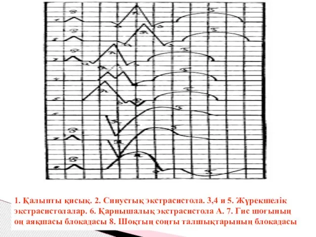 1. Қалыпты қисық. 2. Синустық экстрасистола. 3,4 и 5. Жүрекшелік экстрасистолалар.