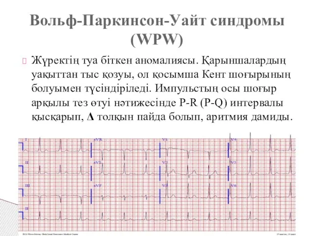 Вольф-Паркинсон-Уайт синдромы (WPW) Жүректің туа біткен аномалиясы. Қарыншалардың уақыттан тыс қозуы,