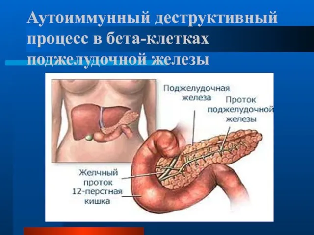 Аутоиммунный деструктивный процесс в бета-клетках поджелудочной железы