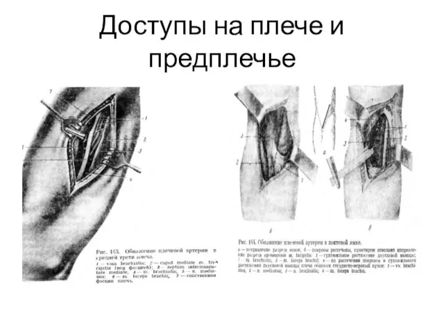 Доступы на плече и предплечье