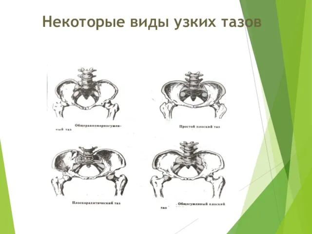 Некоторые виды узких тазов