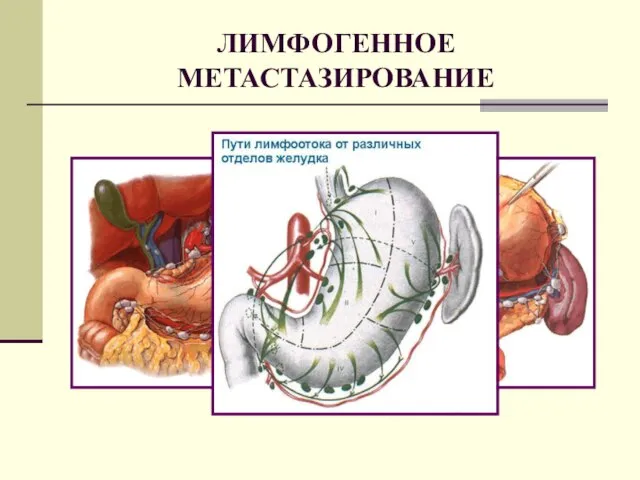 ЛИМФОГЕННОЕ МЕТАСТАЗИРОВАНИЕ РАСПРОСТРАНЕНИЕ ПО ЛИМФАТИЧЕСКОЙ СИСТЕМЕ