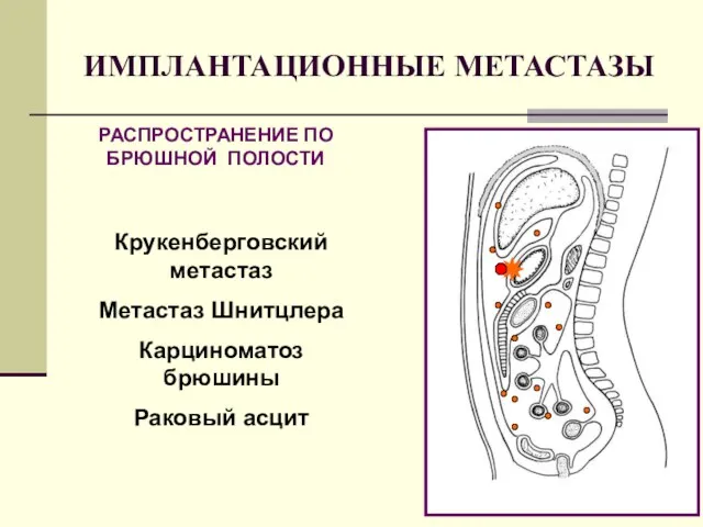 ИМПЛАНТАЦИОННЫЕ МЕТАСТАЗЫ РАСПРОСТРАНЕНИЕ ПО БРЮШНОЙ ПОЛОСТИ Крукенберговский метастаз Метастаз Шнитцлера Карциноматоз брюшины Раковый асцит