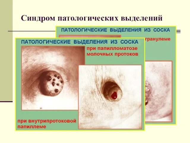 Синдром патологических выделений