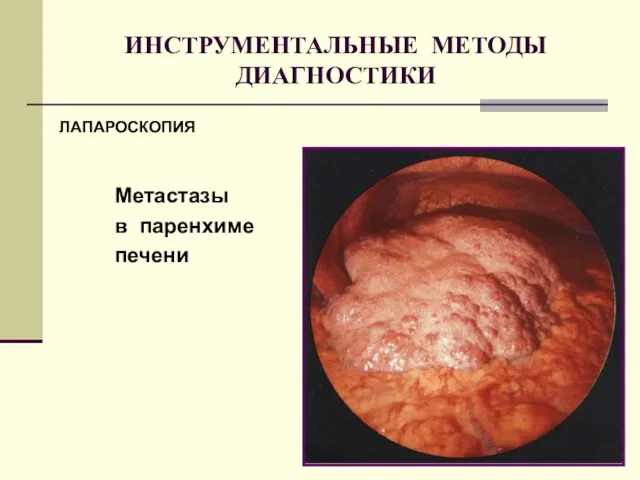 ИНСТРУМЕНТАЛЬНЫЕ МЕТОДЫ ДИАГНОСТИКИ ЛАПАРОСКОПИЯ Метастазы в паренхиме печени ЛАПАРОСКОПИЯ