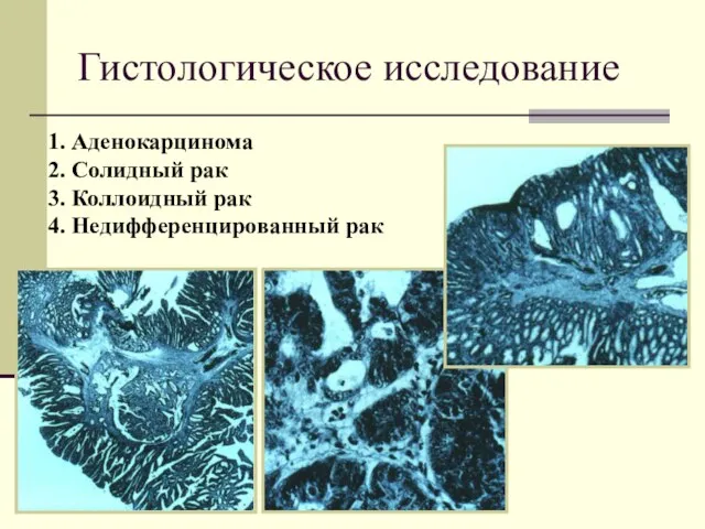 1. Аденокарцинома 2. Солидный рак 3. Коллоидный рак 4. Недифференцированный рак Гистологическое исследование