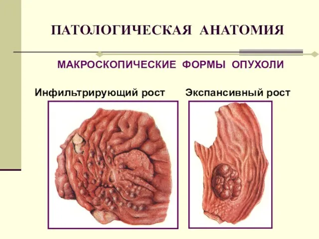 ПАТОЛОГИЧЕСКАЯ АНАТОМИЯ МАКРОСКОПИЧЕСКИЕ ФОРМЫ ОПУХОЛИ Инфильтрирующий рост Экспансивный рост