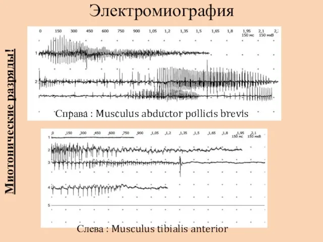 Электромиография Справа : Musculus abductor pollicis brevis Слева : Musculus tibialis anterior Миотонические разряды!
