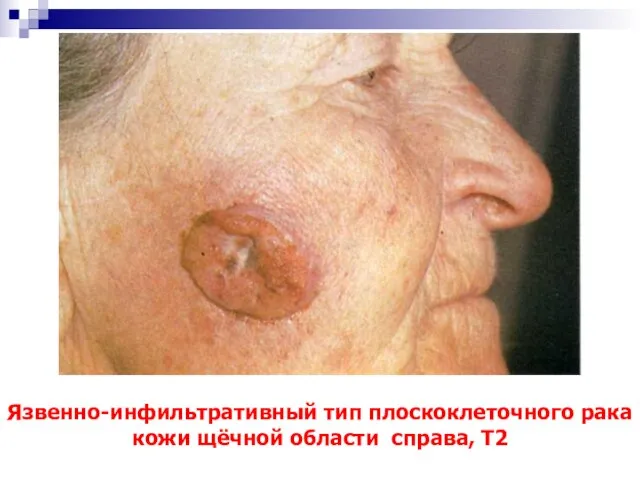 Язвенно-инфильтративный тип плоскоклеточного рака кожи щёчной области справа, Т2