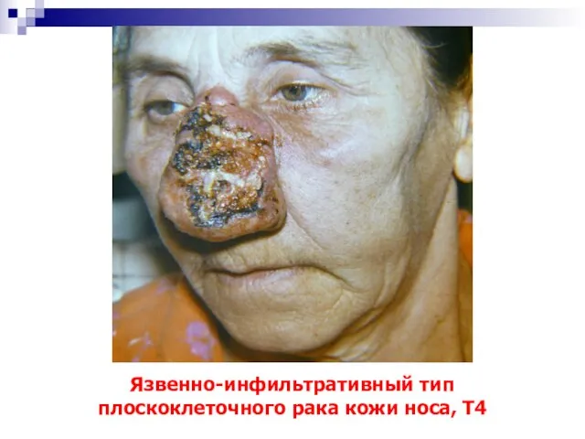 Язвенно-инфильтративный тип плоскоклеточного рака кожи носа, Т4