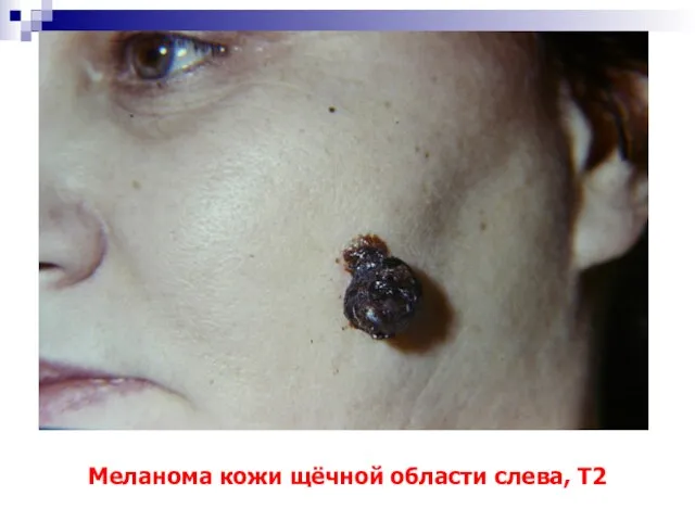Меланома кожи щёчной области слева, Т2