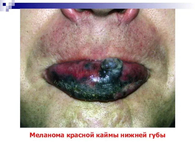 Меланома красной каймы нижней губы