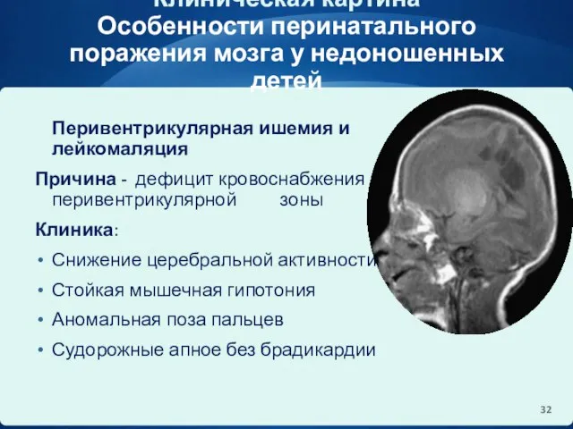 Клиническая картина Особенности перинатального поражения мозга у недоношенных детей Перивентрикулярная ишемия