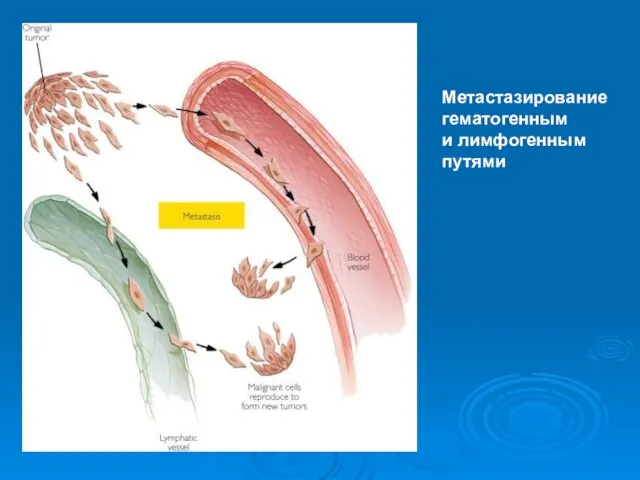 Метастазирование гематогенным и лимфогенным путями