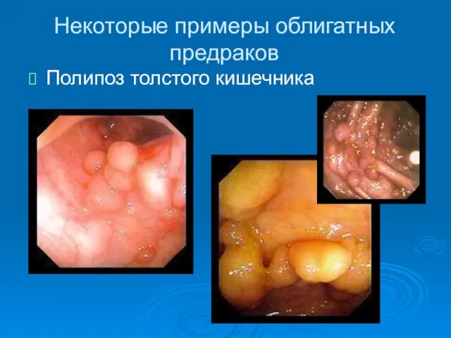 Некоторые примеры облигатных предраков Полипоз толстого кишечника