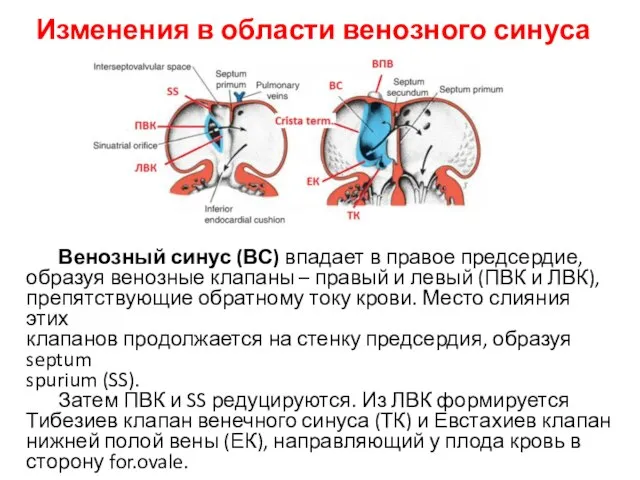 Изменения в области венозного синуса Венозный синус (ВС) впадает в правое