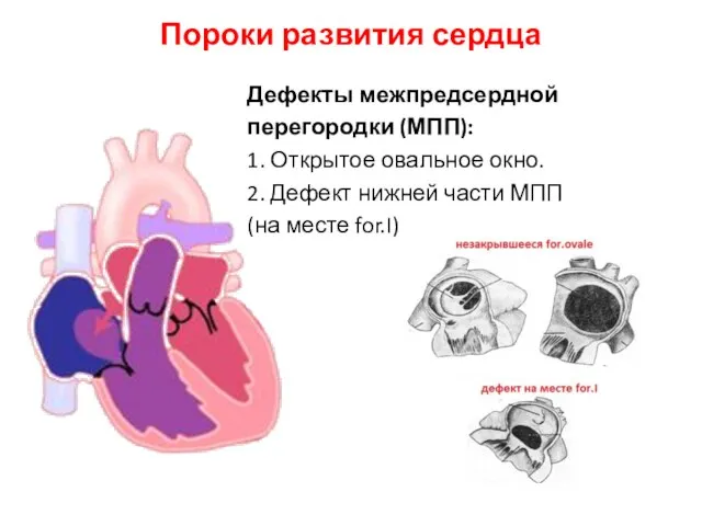 Пороки развития сердца Дефекты межпредсердной перегородки (МПП): 1. Открытое овальное окно.