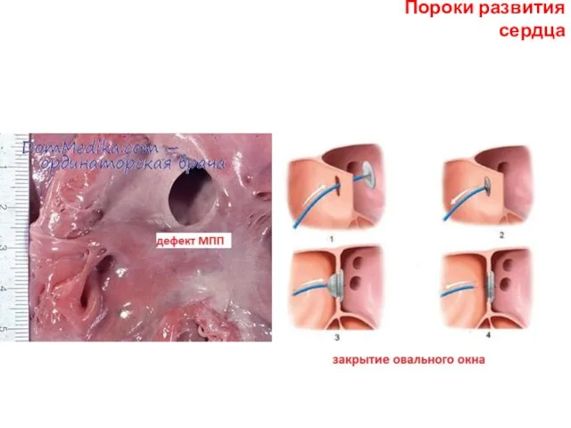 Пороки развития сердца