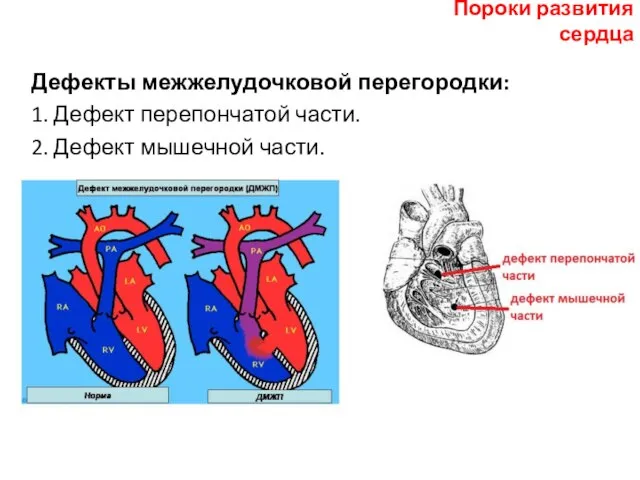 Дефекты межжелудочковой перегородки: 1. Дефект перепончатой части. 2. Дефект мышечной части. Пороки развития сердца