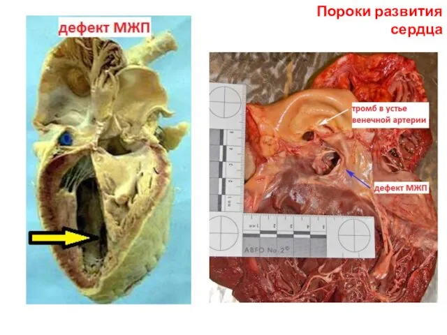 Пороки развития сердца