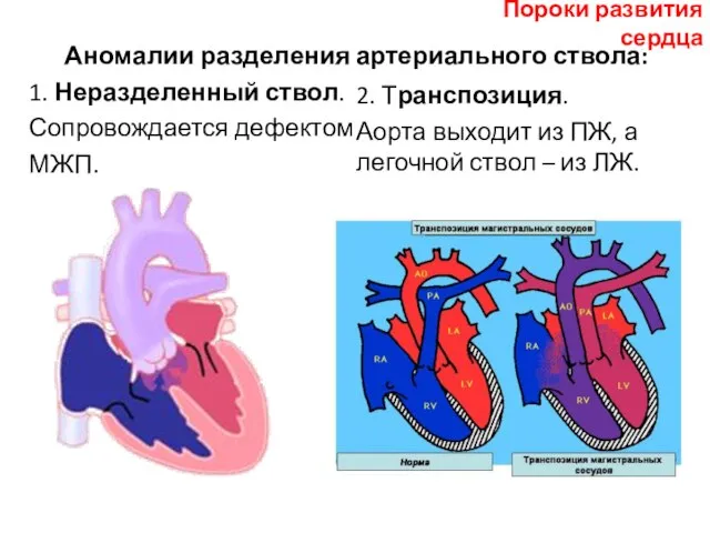 Аномалии разделения артериального ствола: 1. Неразделенный ствол. Сопровождается дефектом МЖП. 2.