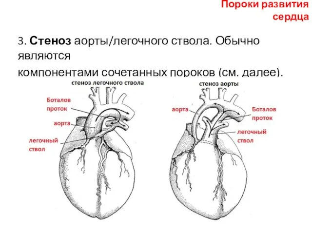 3. Стеноз аорты/легочного ствола. Обычно являются компонентами сочетанных пороков (см. далее). Пороки развития сердца