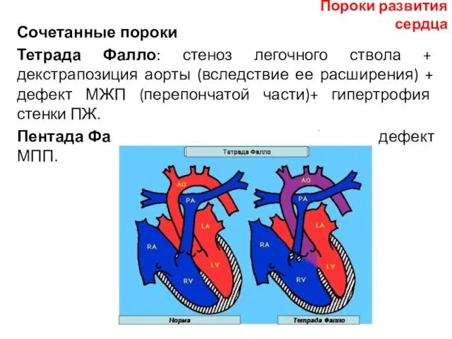 Сочетанные пороки Тетрада Фалло: стеноз легочного ствола + декстрапозиция аорты (вследствие