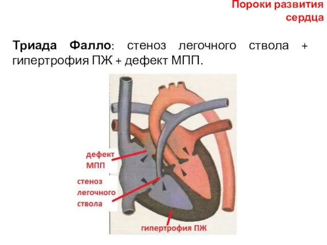 Триада Фалло: стеноз легочного ствола + гипертрофия ПЖ + дефект МПП. Пороки развития сердца